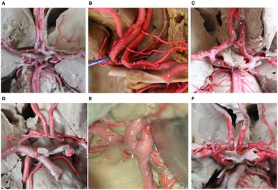 Anterior Communicating Artery Aneurysms: Anatomical Considerations and Microsurgical Strategies